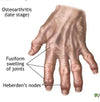 What are some good treatment for arthritis in hands and body. - LL Health Supplement 